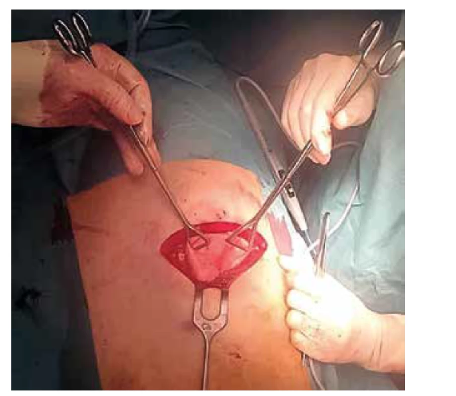 Herniace plicní tkáně defektem hrudní stěny<br>
Fig. 3: Herniation of the lung tissue through the chest
wall defect
