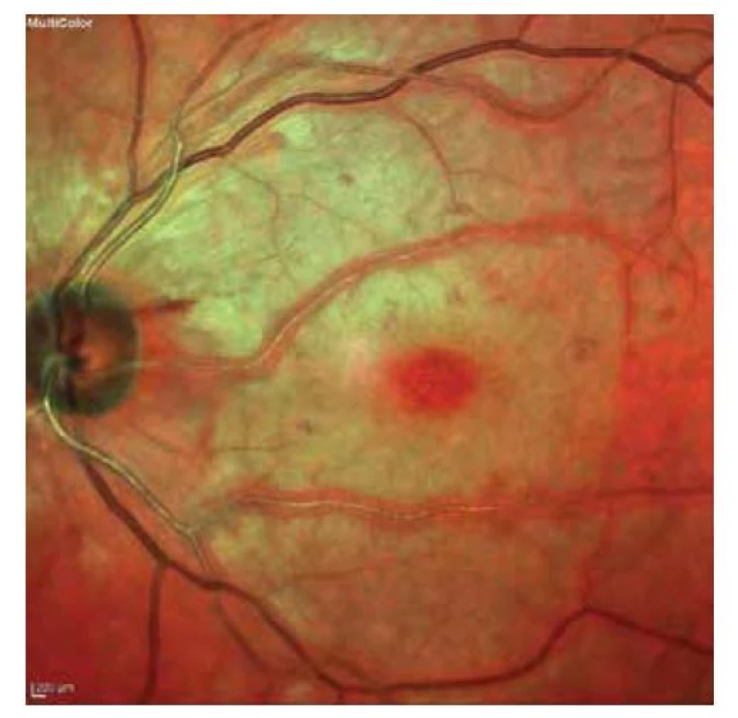 Bledý vzhled sítnice s třešňovou skvrnou v makule
– příznaky CRAO trvající 6,5 hodiny<br>
CRAO – central retinal artery occlusion