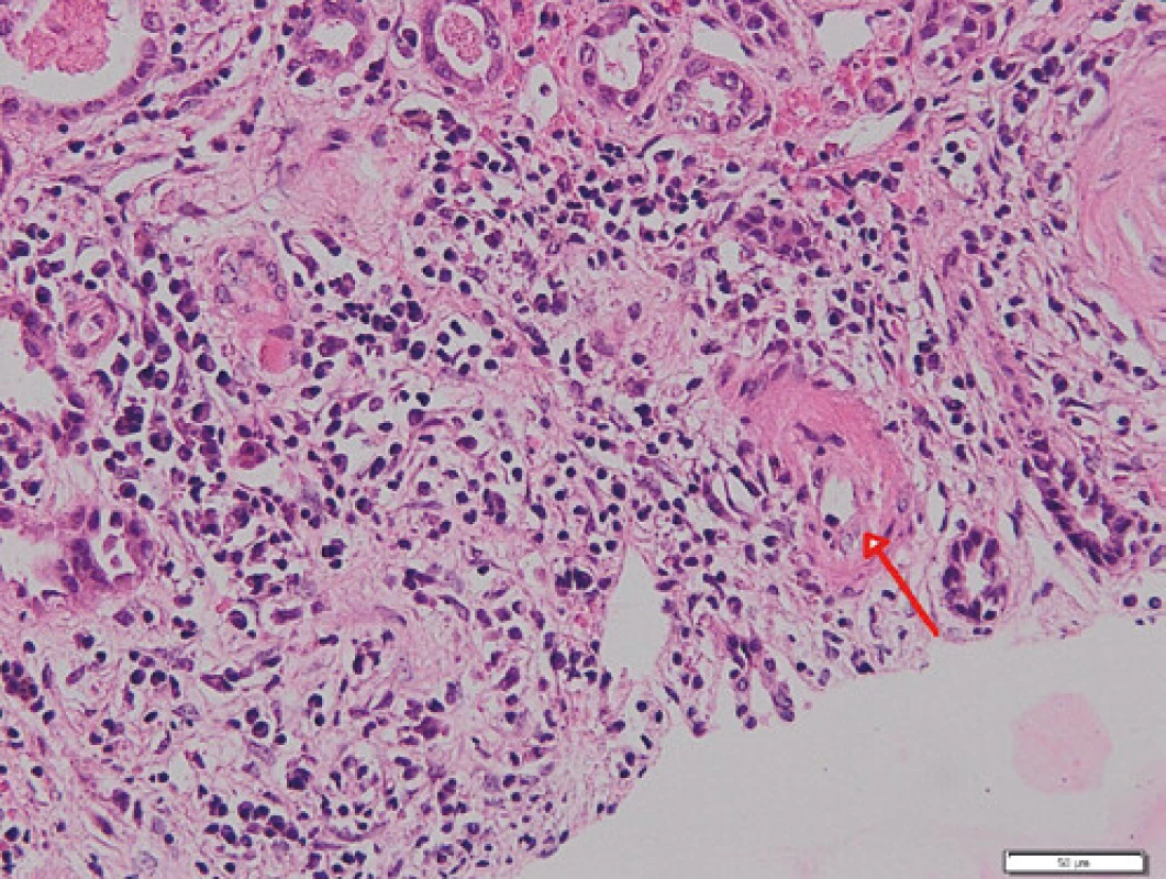 Arteriola s fibrinoidní nekrózou (červená šipka); barvení HE