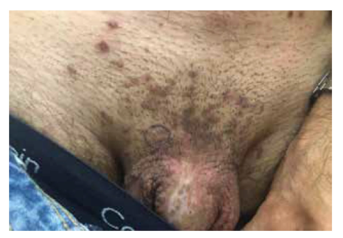 Bowenoidní papulóza u kořene penisu