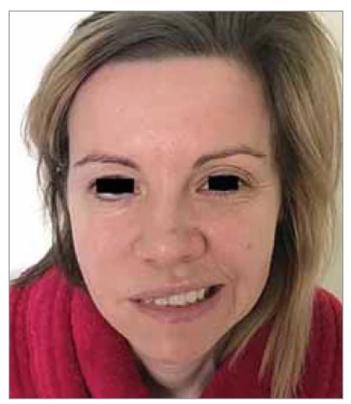 Zobrazenie predoperačnej parézy
tvárového nervu vpravo.<br>
Fig. 4. Imaging of the preoperative paresis
of the facial nerveon the right.