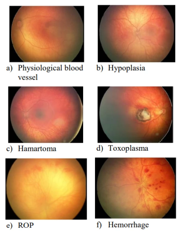  Representative sample of retinal images taken
by RetCam3 with specified diagnosis by the clinical
specialist ophthalmologist in our dataset.