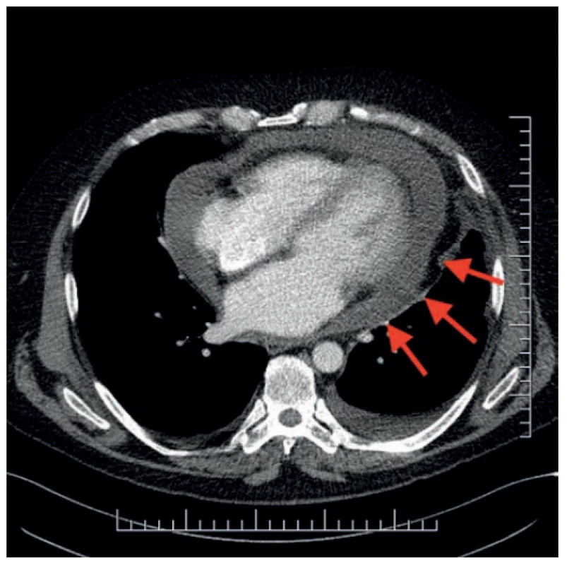 Fluidoperikad na CT hrudníka<br>
Fig. 4. Pericardial eff usion on a chest CT scan