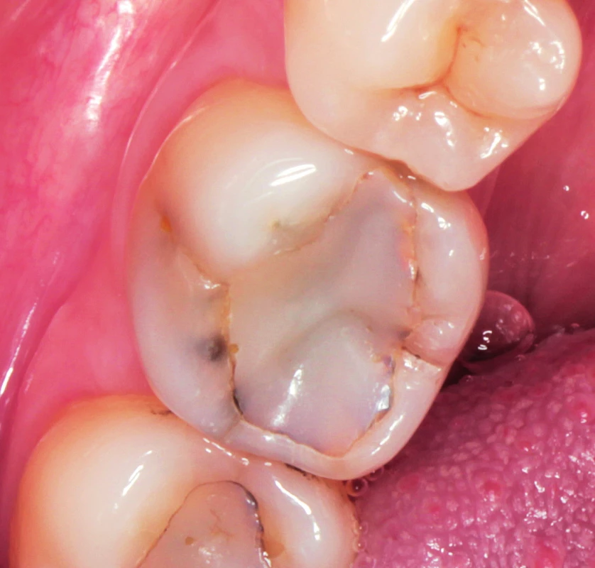 Kompozitní výplň se známkami opotřebení a nevyhovujícího okrajového
uzávěru na zubu