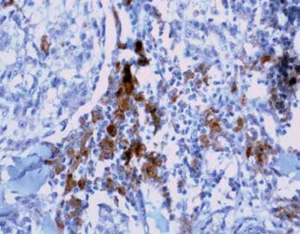 Imunohistochemický průkaz protilátky anti-PD-L1 v tumor infiltrujících
lymfocytech na periferii tumoru (zvětšení 200x).