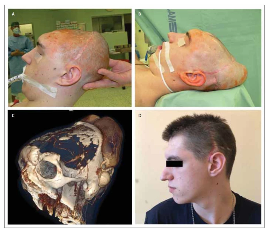 (A) Opadnuté frontální laloky s retrakcí kožního krytu před implantací expandérů. (B) Dilatovaný skalp před vynětím expandérů
a sekundární kranioplastikou. (C) Tří-dimenzionální CT kostní rekonstrukce (VRT) ukazuje defekt po bifrontální dekompresivní kraniektomii
a implantované podkožní expandéry za okrajem dekomprese. Patrná je počínající spontánní reosifikace v oblasti kostního
defektu. (D) Finální výsledek po vynětí expandérů a počítačově modelované kranioplastice porózním polyethylenem.<br>
VRT – volume rendering technique<br>
Fig. 2. (A) Compression of frontal lobes with skin atrophy before the implantation of expanders.. (B) Scalp tissue expansion before
expanders removal and secondary cranioplasty. (C) Three-dimensional CT scan (VRT) showing bone defect after bifrontal decompressive
craniectomy and subcutaneous expanders placed beyond the edge of decompression. An incipient spontaneous reossification in
the area of the bone defect is evident. (D) Final result after expanders removal and custom-made porous polyethylene cranioplasty.<br>
VRT – volume rendering technique
