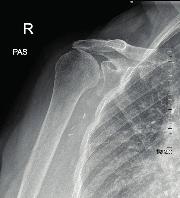 Arthrosis and cranial translation of humeral head on X-ray image