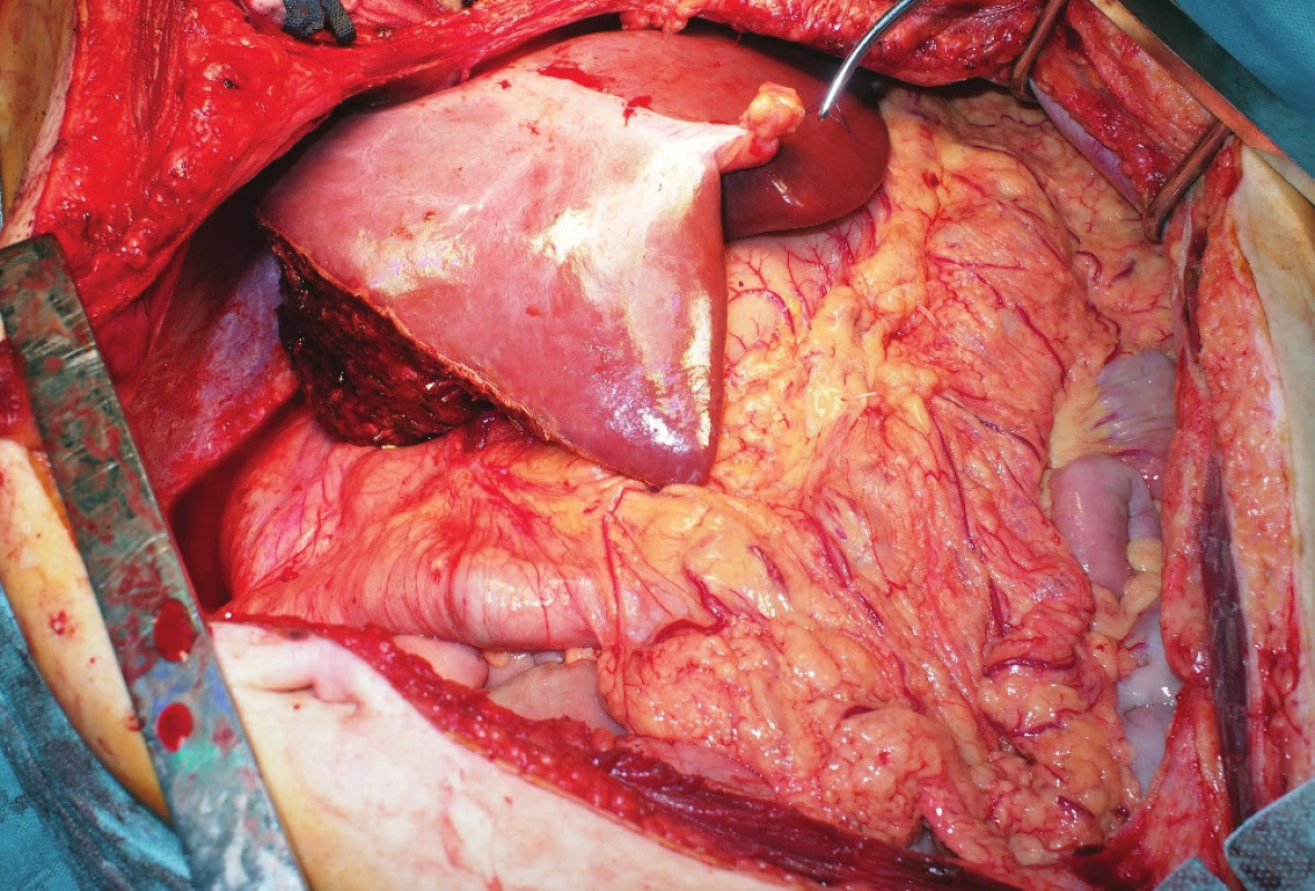 In situ-reduced left hemi-liver graft during the procurement
period