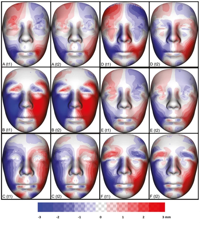Porovnání individuální
asymetrie obličeje šesti
pacientů (5 ) s OAVS
mezi jednotlivými
vyšetřeními v čase t1 a t2
(A–F). Pro každého jedince
byl vytvořen zrcadlový obraz.
Následným zprůměrováním
původního a zrcadlového
obrazu byl vytvořen
dokonale symetrický
individuální obraz obličeje
vyšetřovaného jedince.
Odečtením vrcholů
původního obrazu od obrazu
symetrického byla získána
a pomocí barevných map
vizualizována individuální
asymetrie. Oblasti pozitivních
odchylek od ideální symetrie
jsou vizualizovány červeně,
oblasti negativních odchylek
jsou vizualizovány modře.
Největší rozdíly mezi pravou
a levou stranou nacházíme
v oblasti tváře na postižené
straně od zevního koutku oka
po ipsilaterální koutek rtu.
Barevné mapy v čase t1 a t2
u daného jedince ukazují jen
minimální změny.<br>
Fig. 6
Comparison of individual
facial asymmetry six patients
(5 examinations at t1 and t2 (A–F).
A mirror image was created for
each individual. Subsequent
averaging of the original and
mirror images produced
a perfectly symmetrical
individual image of the pacient's
face. By subtracting the peaks
of the original image from the
symmetric image, individual
asymmetry was obtained and
visualized using color maps.
Areas of positive deviations from
ideal symmetry are visualized
in red, areas of negative
deviations are visualized in blue.
The biggest diff erences between
the right and left sides are
in the area of the face
on the aff ected side from
the outer corner of the eye
to the ipsilateral corner
of the lip. Color maps at time t1
and t2 for a given individual
show only minimal changes.