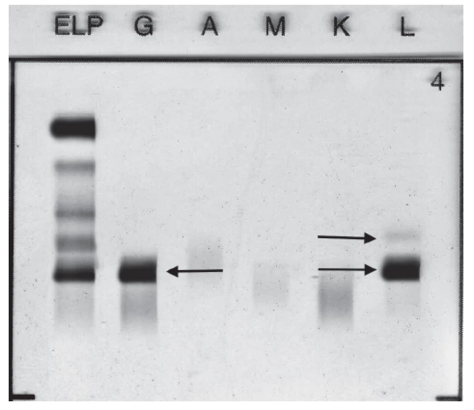 Immunofixation electrophoresis of patient´s pleural
fluid sample presenting paraprotein IgG Lambda and FLC
Lambda.