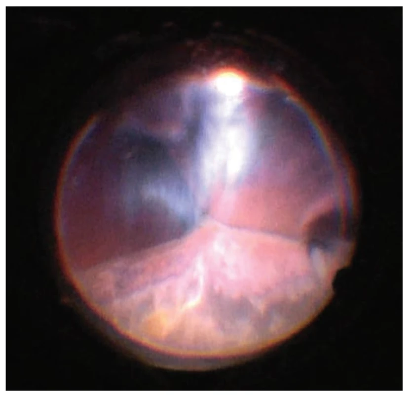 Pohled na oční pozadí v průběhu postupného
snižování výšky ablací, apozice protilehlých částí sítnice
se pozvolna „rozlepují“, začíná být vidět reflex od očního
pozadí. Světlo se odráží od sklivcových vláken, která jsou
nahuštěna do retrolentálního prostoru. Snímek z peroperačního
videa – z pohledu chirurga