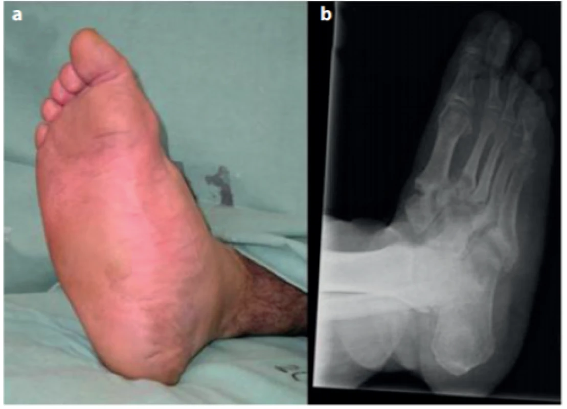 Aktivní Charcotova noha (a), RTG nález s typickým postižením skeletu (b)