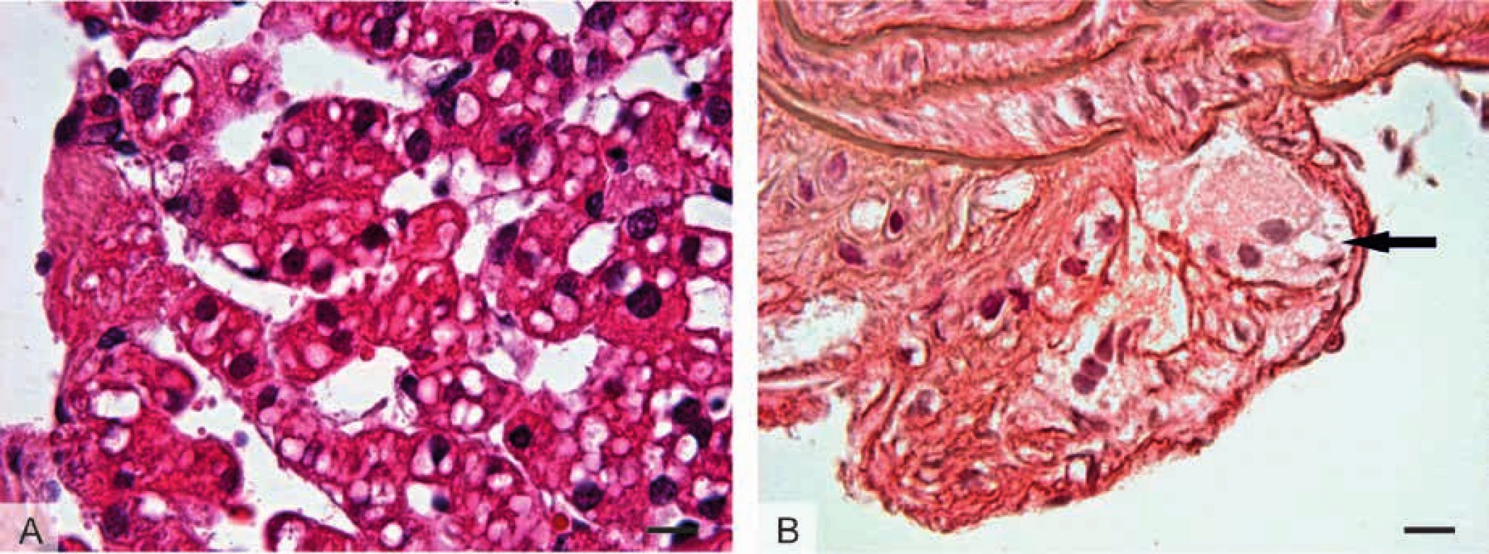 Histologický obraz tkání u patologických stavů
spojených s tukovými kapénkami: