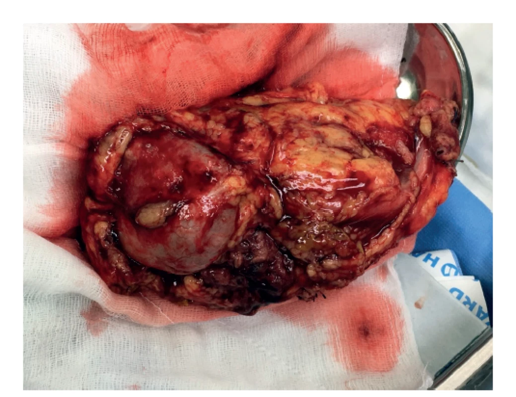 Resekát pravej obličky s tumorom<br>
Fig. 6: Right kidney resection with the tumor