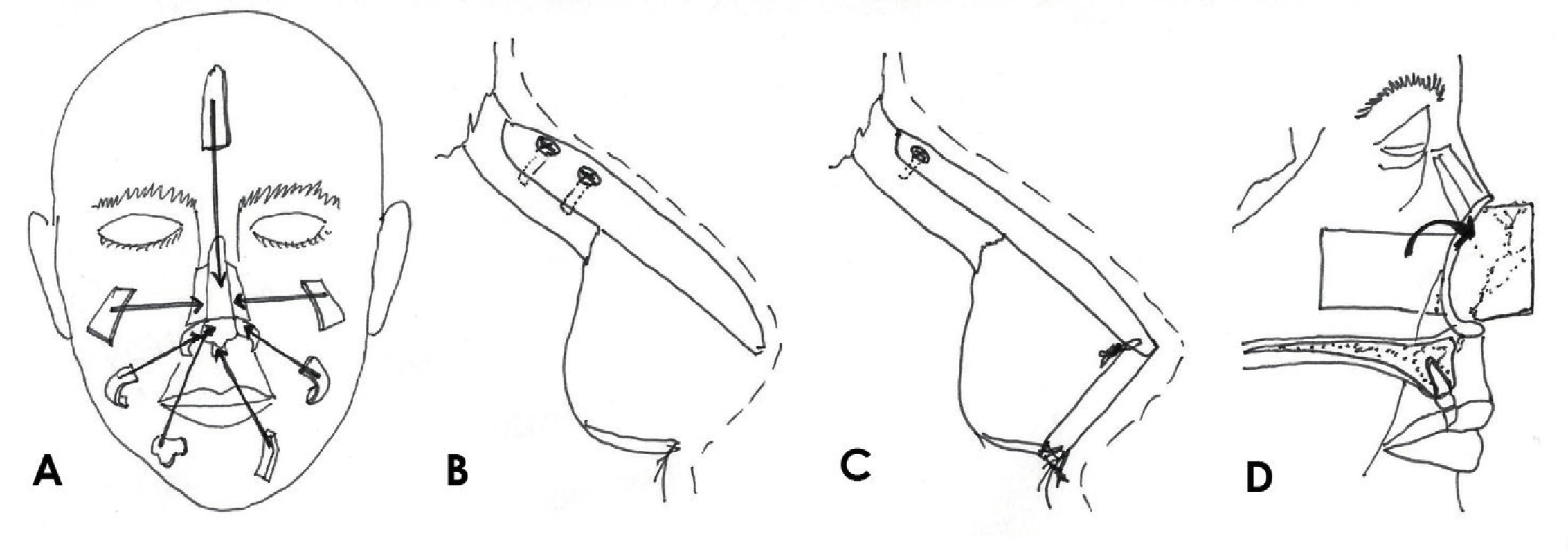 Rekonstukce opěrné struktury nosu: A) jednotlivé chrupavčité a kostěné součásti skeletu, B) konzolový
štěp, C) L-štěp, D) kompozitní pivotální lalok.
Zdroj: Kresba autora podle Thornton JF, Griffin, John R. Nasal Reconstruction. Sel Read Plast. Surg. 2006,
10(12):6-8.