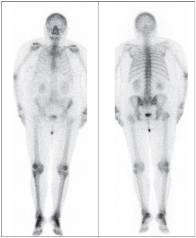 Na celotělovém snímku skeletu v říjnu 2012 je patrna vyšší akumulace radiofarmaka v oblasti L5 vpravo,
dále v kolenou a v nártech odpovídající degenerativním
změnám. Akumulace ve skeletu je vcelku fyziologická.
