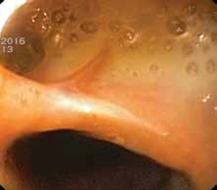 Anastomotic leak in cervical anastomosis following
oesophagectomy.
Obr. 7. Anastomotický leak v krční anastomóze po ezofagektomii.