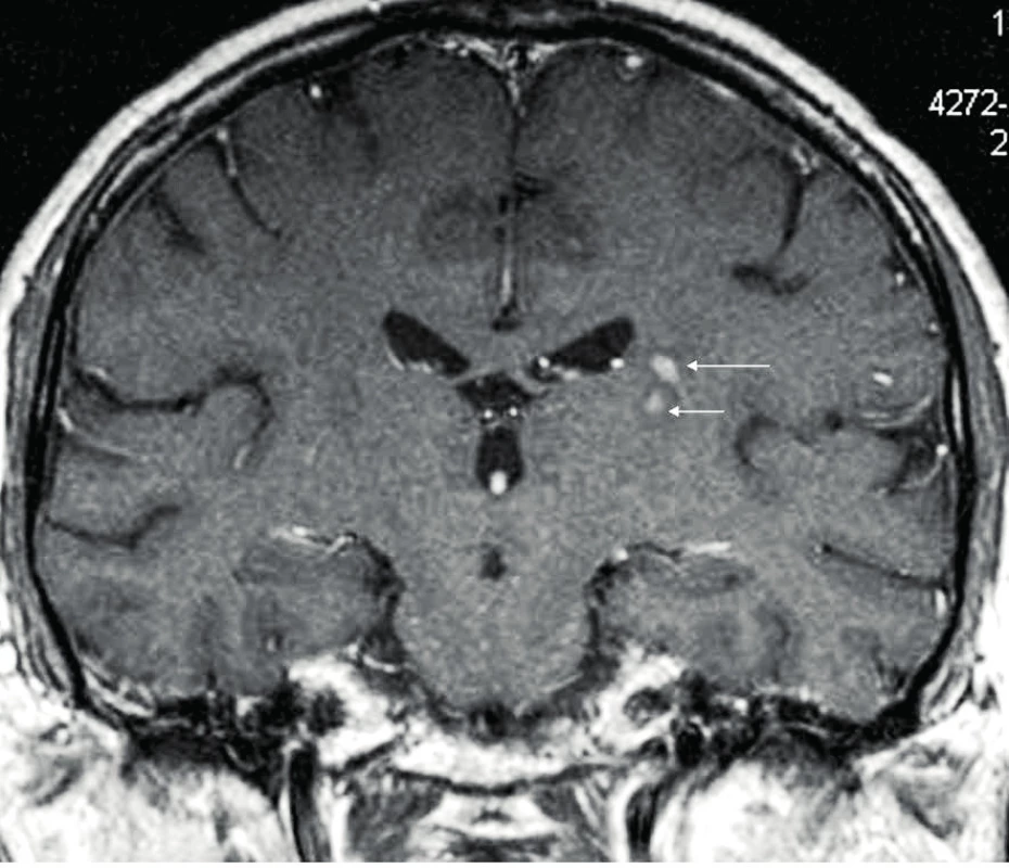MR mozku u pacienta s ECD – zachycena další ložiska ECD