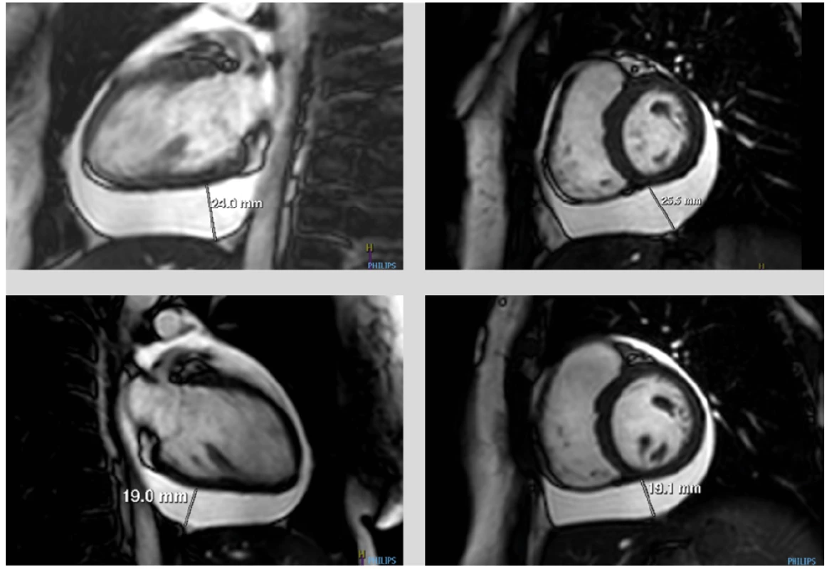 (a, b, c, d) MRI srdce. Dynamické zobrazování ve vertikální dlouhé ose (dvoudutinová projekce) a krátké ose. Patrný perikadiální výpotek s maximem
pod spodní stěnou levé komory při vstupním vyšetření (a, b) a jeho jednoznačná regrese po 2 dnech kortikoterapie (c, d)