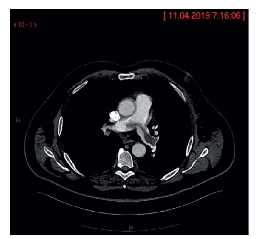 Nádorový embolus vo vetvení pľúcnice<br>
Fig. 7: Fig. 7: Tumor embolus at the branching point of the
pulmonary artery