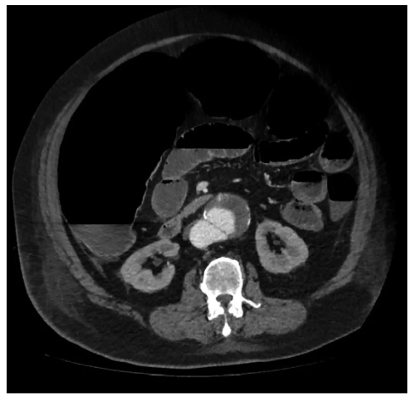 Paralytický ileus a aneurysma abdominální aorty <br>
Fig. 1: Paralytic ileus and abdominal aortic aneurysm