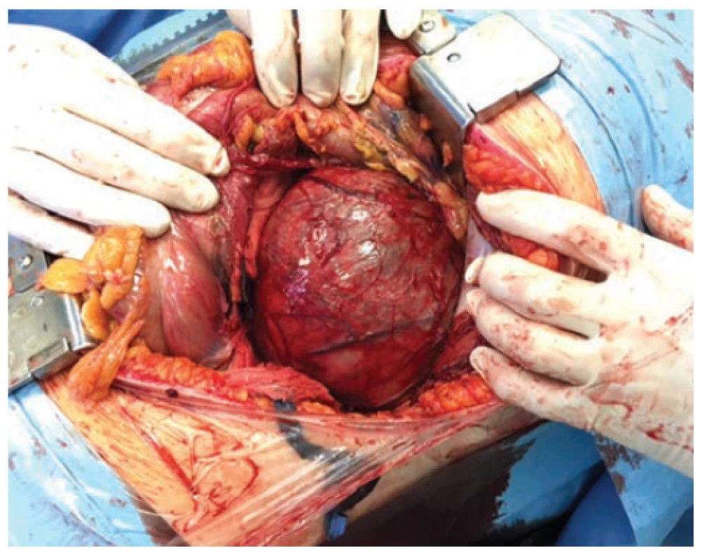 Retroperitoneal tumor extirpation from lumbothomy
approach