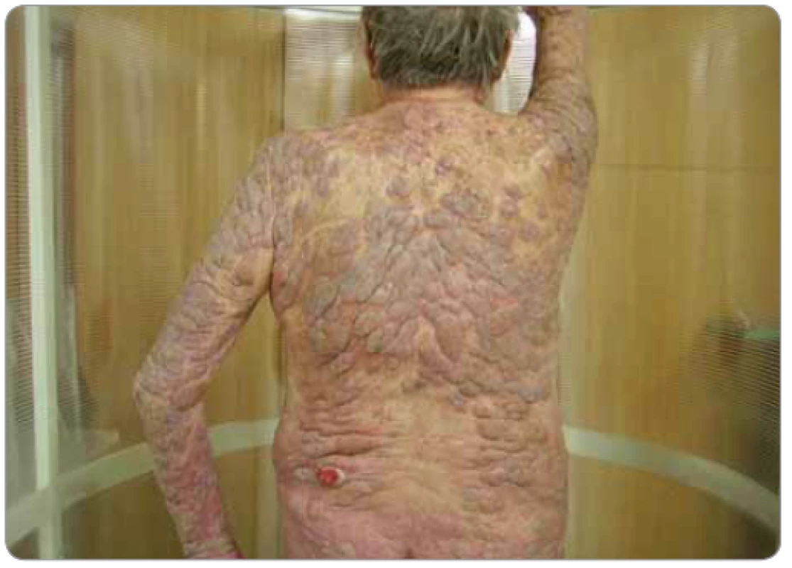 Pacient s tumorózním postižením kůže mycosis fungoides celého těla před zahájením celotělového ozařování kůže elektronovým svazkem.
