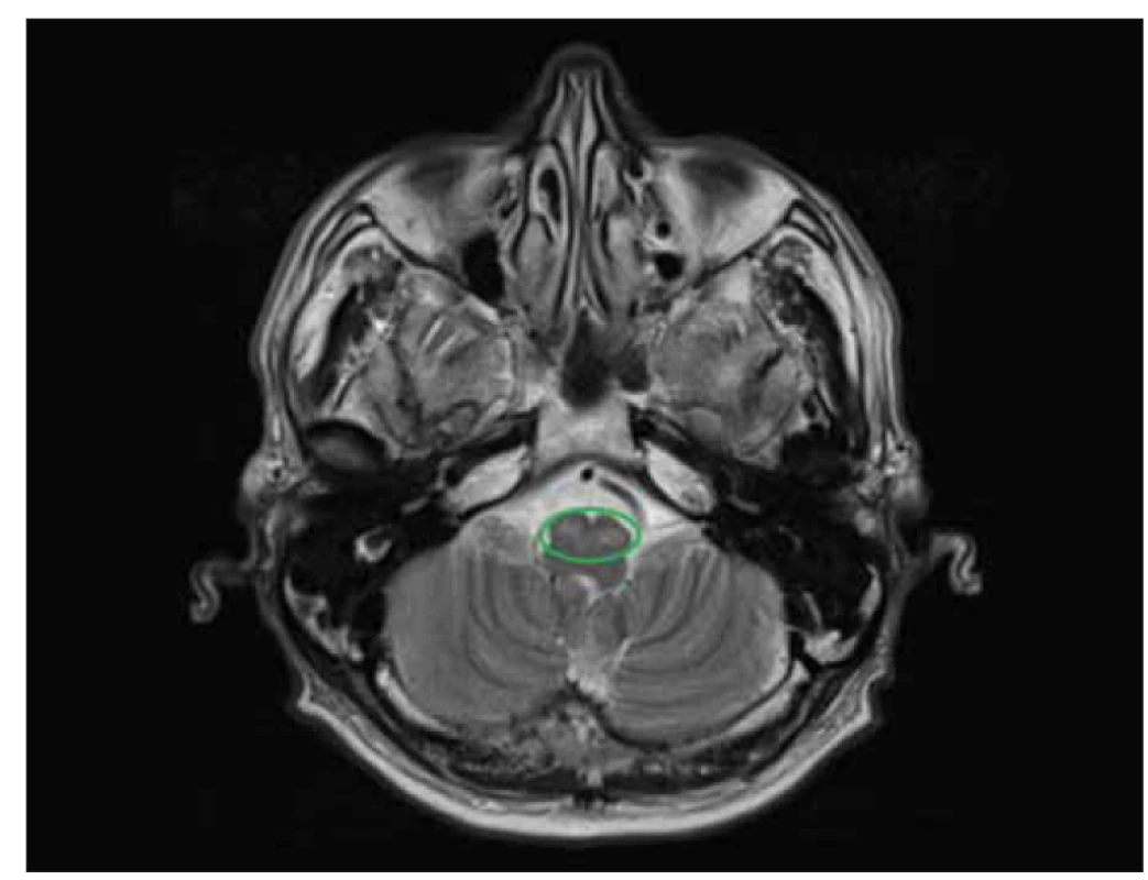 MR mozku, T2 vážená sekvence axiálně – mírná symetrická hypertrofie dolních
olivární jader, která jsou bilaterálně s patologicky zvýšeným signálem.<br>
Dif. dg. – další příčiny vysokého T2 váženého signálu ve ventrální části prodloužené míchy:<br>
• demyelinizace v souvislosti s roztroušenou sklerózou;<br>
• tumor (astrocytom, metastáza, lymfom);<br>
• léze postihující kortikospinální dráhu (Walleriánská degenerace, adrenoleukodystrofie,
amyotrofická laterální skleróza);<br>
• infarkt v povodí vertebrobazilární perforující tepny – většina medulárních infarktů nastává
v povodí arteria posterior inferior cerebelli a postihuje posterolaterální část prodloužené
míchy (např. při disekci vertebrální tepny). Alternativně, medulární infarkty mohou být spojeny
s okluzí perforující větví přední míšní tepny nebo vertebrálních tepen a mají paramediální
lokalizaci;<br>
• infekční/zánětlivý proces (tuberkulóza, sarkoidóza, HIV/AIDS, rhombencephalitis) [10].<br>
Fig. 2. Brain MRI, T2 weighted axial sequence – imaging at the level of the inferior olivary
nuclei, which are bilateral with pathologically increased signal and mild symmetric
hypertrophy.<br>
Dif. dg. – other causes of high T2 weighted signal in the ventral part of the medulla
oblongata:<br>
• demyelination in the context of multiple sclerosis;<br>
• tumor (astrocytoma, metastasis, lymphoma);<br>
• lesions affecting the corticospinal tract (Wallerian degeneration, adrenoleukodystrophy,
amyotrophic lateral sclerosis);<br>
• infarction in the territory of the vertebrobasilar perforating artery – most of the medullary
infarctions occur in the posterior inferior cerebellar artery territory and affect the posterolateral
part of the medulla oblongata (for example, in vertebral artery dissection). Alternatively,
medullary infarctions may be associated with the occlusion of perforating branches of
the anterior spinal artery or vertebral arteries and are located in the paramedian region;<br>
• infectious/inflammatory process – tuberculosis, sarcoidosis, HIV/AIDS, rhombencephalitis.