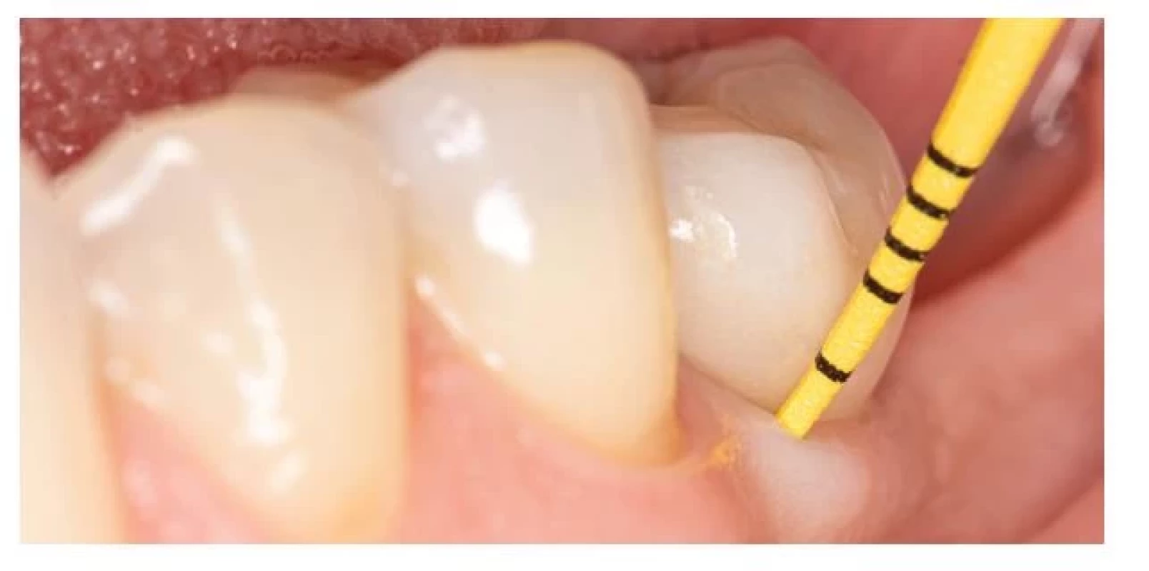 Klinické vyšetrenie pomocou
plastickej parodontálnej
sondy.<br>
Fig. 5
Clinical examination using
plastic periodontal probe.