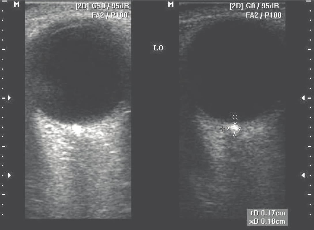 USG imaging B-scan of optic disc drusens – Group III (according to size)