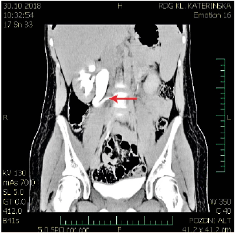 CT s i.v. aplikací kontrastní látky – zobrazení retrokaválního ureteru s typickým tvarem „rybářského háčku“ v oblasti L3 obratle – označeno červenou šipkou.<br>
Computed Tomography (CT) with intravenous application of a contrast. Typical imaging of an „S“ shaped retrocaval ureter (so called „fishing hook“) by 3rd lumbal vertebra. Marked with a red arrow.