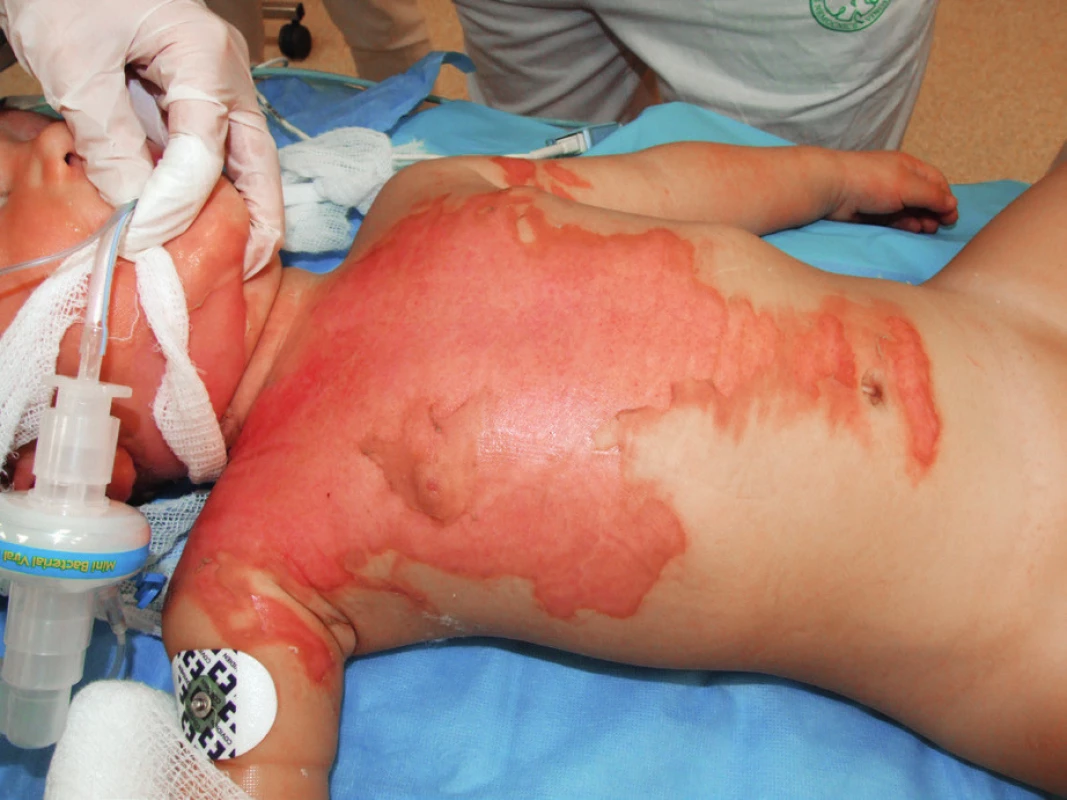 A 15-month-old boy admitted due to superficial seconddegree
burns over 20% of total body surface area