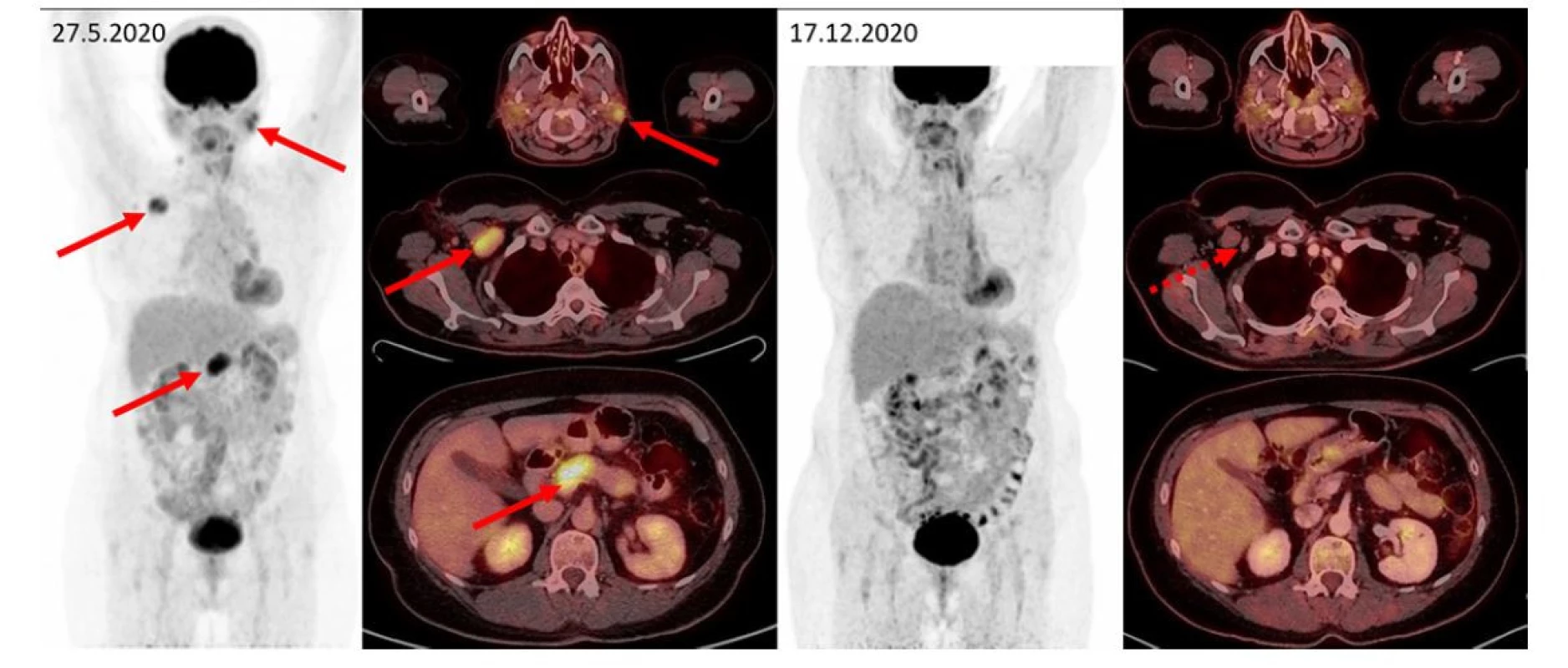 F–FD6 PET/CT vyšetření u pacientky s bolestmi v dolní polovině břicha a zvětšením pankreatu. Šipkami jsou označeny metabolicky aktivní infiltrace
příušních slinných žláz, zvětšená aktivní uzlina vpravo pod prsními svaly, infiltrace přechodu hlavy a těla pankreatu. Další méně výrazná ložiska
(vlevo v gll. submandibularis, uzlinách na krku, kaudě pankreatu) jsou patrna na MIP zobrazení, ale nejsou označena. Tato metabolicky aktivní ložiska
při kontrolním vyšetření zanikají, drobné reziduum bez zvýšené metabolické aktivity je patrné jen vpravo subpektorálně. Pacientka měla dva cytologické
odběry z pankreatu, jeden vyšel jako zánět, druhý jako adenocarcinom. Vymizení infiltrace po léčbě rituximabem, cyklofosfamidem a dexametazonem
potvrdilo etiologii v IgG4-RD a vyloučilo adenokarcinom pankreatu, který by na tuto léčbu nereagoval