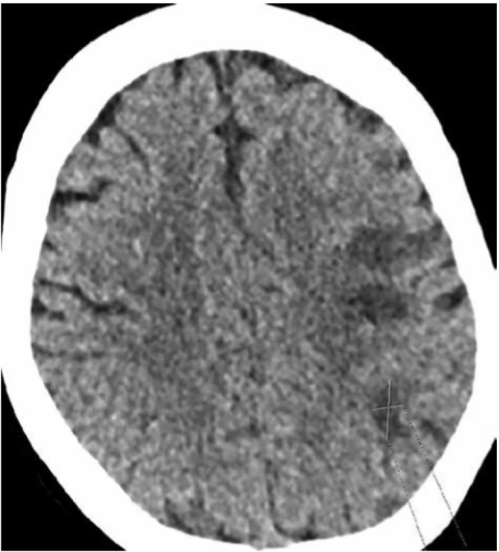 Akutní ischemická ložiska v levé mozkové hemisféře <br>
Fig. 3. Acute ischemic lesions in the left cerebral hemisphere