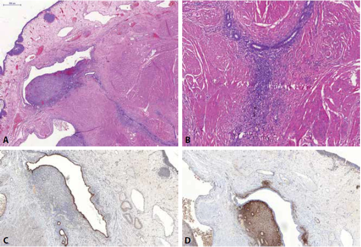 Část stěny močového měchýře s ložisky endometriózy. Na povrchu patrný urotel, hluboko ve stěně pak ložiska vitálních endometriální struktur, propagující se až hluboko do muscularis propria (A). Patrná je přítomnost glandulární i stromální komponenty (B). Imunohistochemicky je typická jaderná pozitivita glandulárních struktur v PAX8 (C) a pozitivita endometriálního stromatu v CD10 (D).