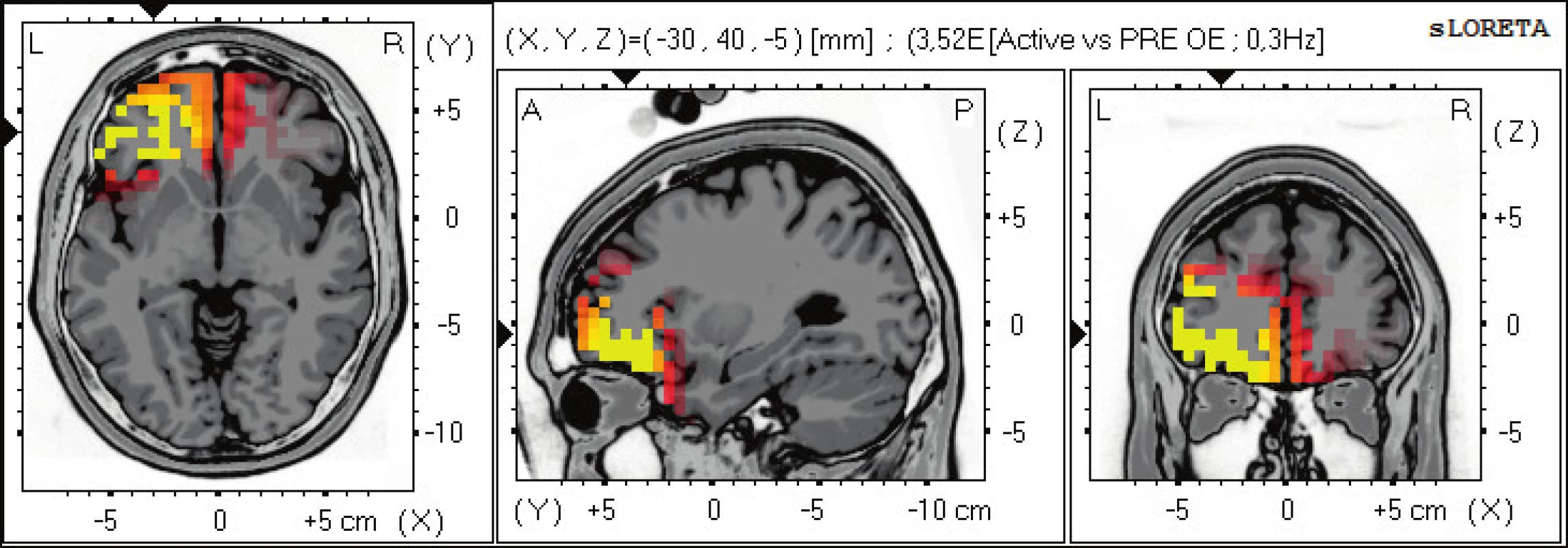 Statistické ne-parametrické mapy sLORETA diference v alfa-2 pásmu při porovnání aktivního provedení pohybu oproti klidovému
záznamu při otevřených očích. Červená a žlutá barva znamená zvýšení zdrojové aktivity ve frontálních oblastech BAs 11, 47, 10. Anatomické
řezy Talairachova obrazu mají šedou barvu (L – vlevo, R – vpravo).