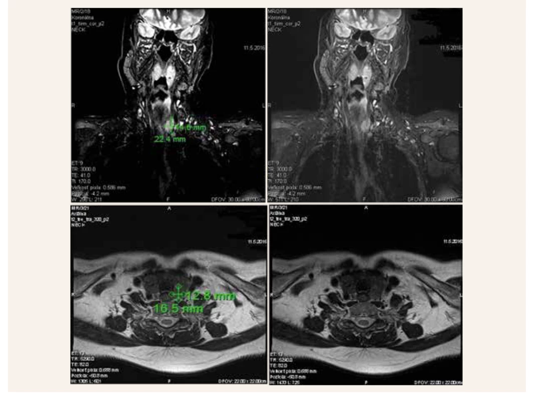 MRI-vyšetrenie krku (2016). Na T1 koronárnych sekvenciách (TIRM) je patrný hypersignálny uzol v ľavom laloku
štítnej žľazy, ktorý bol pôvodne mylne považovaný za primárny uzol štítnej žľazy. Neskôr sa však ukázalo,
že sa jedná o intraparenchýmovo uložené zväčšené prištítne teliesko, ktoré bolo infiltrované karcinómom PT.<br>
Dolné dva obrázky zobrazujú tento uzol v transverzálnej rovine v T2 váženej sekvencii (TSE sekvencia)