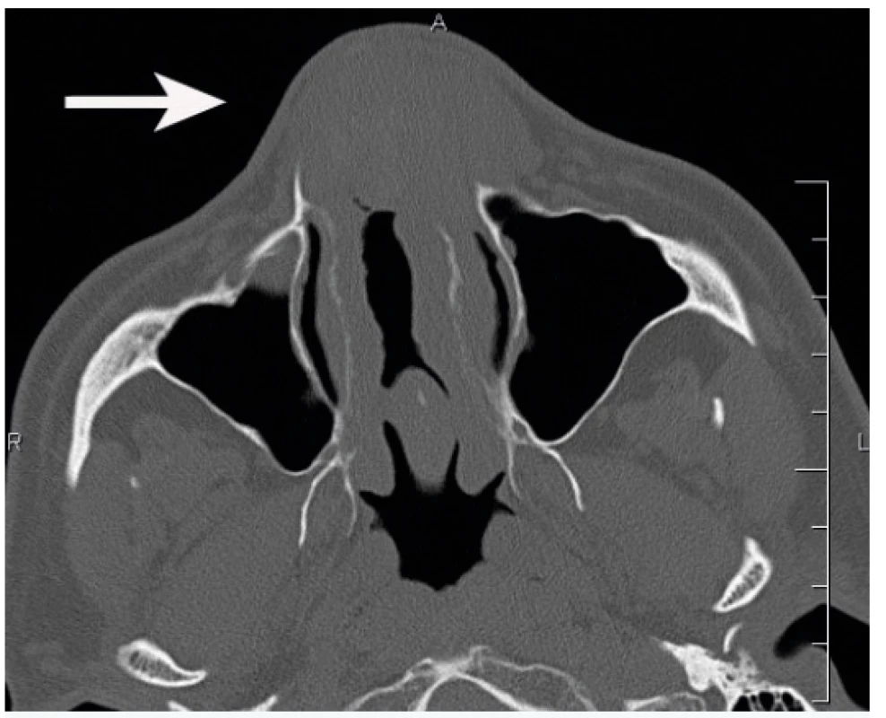 Computed tomographic axial scan showing a softtissue,
expansive lesion in the frontal part of the nasal cavity
(arrow)