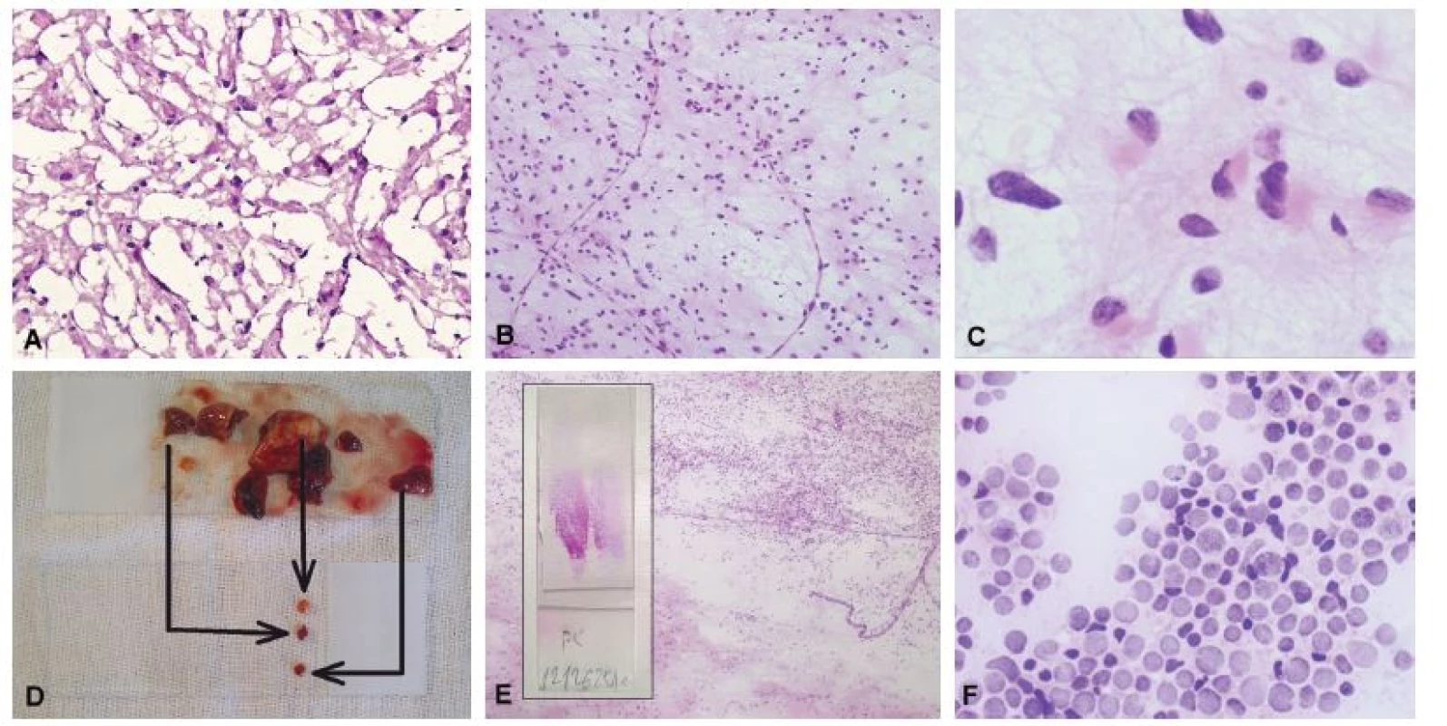 A) Biopsia tumoru frontálneho laloka u 31-ročného muža. Zmrazením tkaniva došlo k vzniku kryštálikov ľadu a potrhaniu tkaniva. Aj keď sú nepravidelné
a hyperchromatické jadrá sugestívne pre diagnózu gliómu, architektoniku nemožno spoľahlivo hodnotiť. (B) Gliálne lézie sa v náterovej cytológii prezentejú
skupinami buniek, ktoré sú vzájomne spojené eozinofilnými gliálnymi výbežkami. (C) Detailný pohľad na nádorové bunky potvrdil prítomnosť eozinofilnej
cytoplazmy s gliálnymi výbežkami, jadrovú hyperchromáziu a pleomorfiu. Peroperačná diagnóza: low-grade primárny (astrocytárny) novotvar. Definitívna
diagnóza: difúzny astrocytóm, grade II. (D) Pomocou náterovej cytológie je možné vyšetriť rôzne časti materiálu na jednom skle. (E) Náter zhotovený z dvoch
rôznych častí materiálu (vložený obrázok) ukázal prítomnosť nádoru – oligodendrogliómu (horná časť obrázku) a normálneho tkaniva mozgu (dolná časť
obrázku). Možnosť porovnania nenádorovej a nádorovej populácie výrazne uľahčuje diagnózu. (F) Cytolyticky zmenené bunky difúzneho veľkobunkového
B-lymfómu. Reprezentatívnejšie (menej cytotolyzované) bunky boli prítomné v inej časti náteru. Na optimálne zachovanie cytologických detailov je nevyhnutná
okamžitá fixácia.
