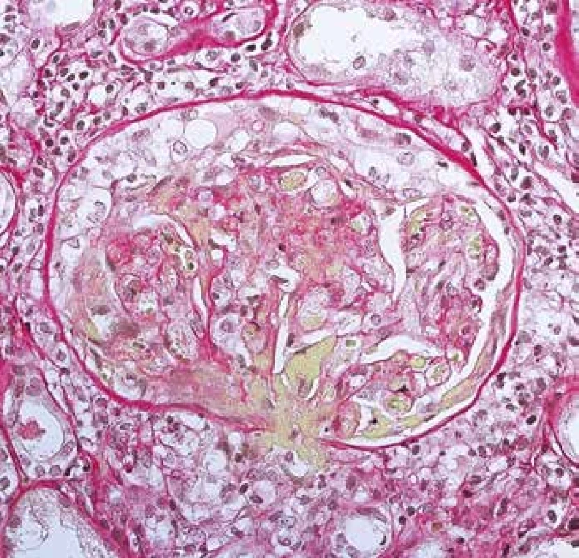 Rozsáhlá nekróza glomerulu, včetně vaskulitidy hilové arterioly (žlutě) a tvořící se objemný epitelový srpek (barvení Srel).