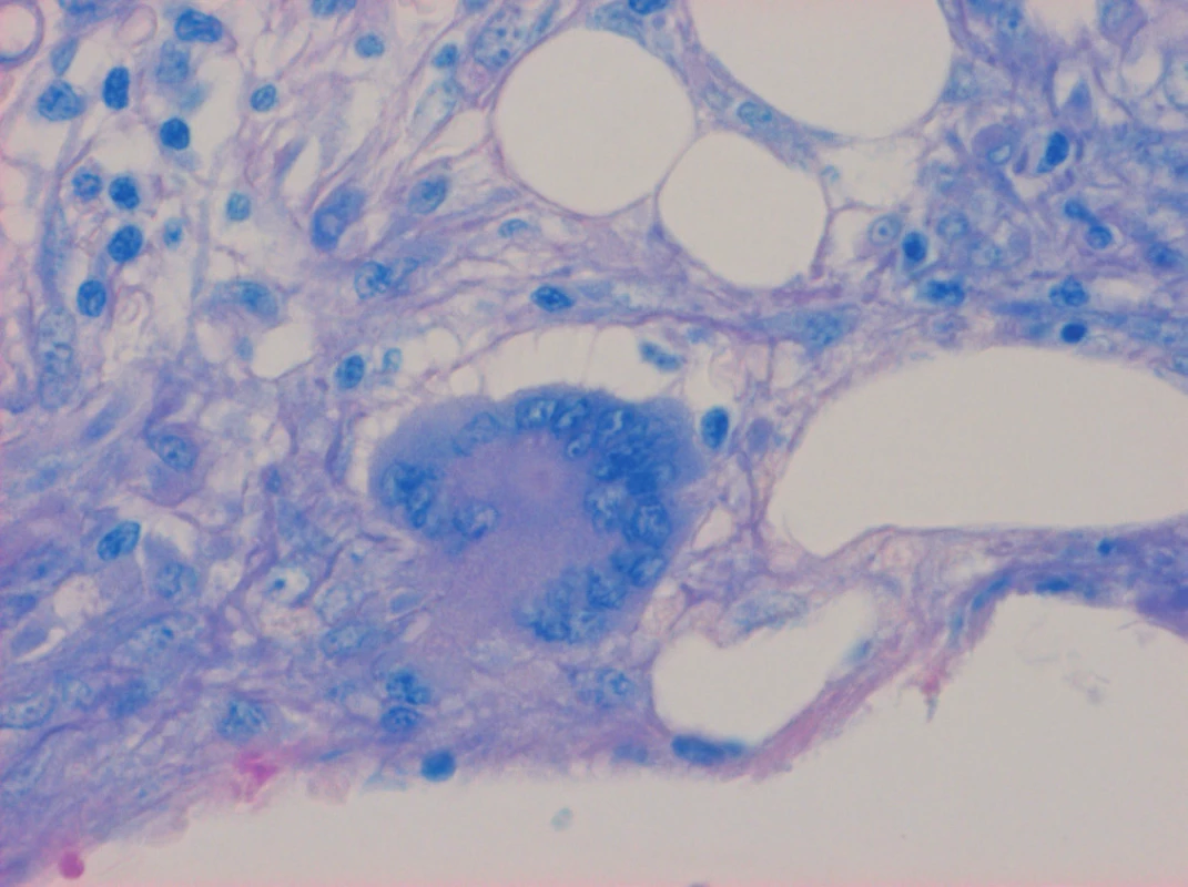 Trepanobiopsie kostní dřeně. Barvení na mykobakteria (Fite),
zvětšení 200×. Langhansova mnohojaderná buňka a epitelioidní buňky,
mykobakteria neidentifikována, periferně nahoře elementy trilineární
hermatopoézy
