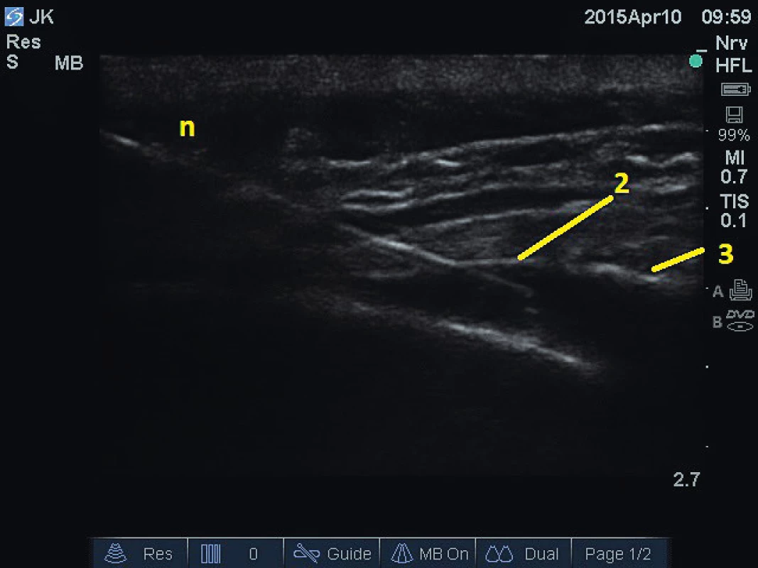 Kaudální epidurální blokáda. 2 – sakrokokcygeální
membrána, 3 – dorzální povrch křížové kosti, n – jehla