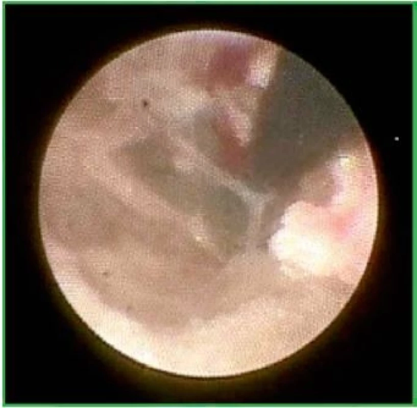Pohled endoskopem při epiduroskopii