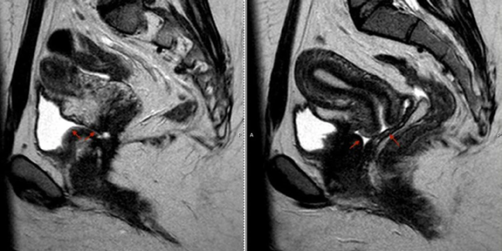 MRI pánve v sagitální projekci přehledně prokazuje přítomnost vezikovaginální píštěle a moči v pochvě (šipky)<br>
Fig. 5. Sagittal view of pelvic MRI demonstrating vesicovaginal fistula and the presence of urine in the vagina (arrows)