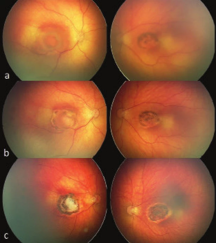 Centrální toxoplasmová chorioretinitida – sítnicový nález
u chlapce s vrozenou toxoplasmovou infekcí na obou očích. Na
snímcích dva týdny po narození chlapce (obr. 4a) zachycena
ložiska aktivní toxoplasmové chorioretinitidy postihující oblast
makuly. Sítnicový nález s odstupem 4 týdnů po nasazení celkové
léčby s ustupující zánětlivou aktivitou a počínajícím sítnicovým
jizvením (obr. 4b) a pokročilá chorioretinální ložiska toxoplasmové
etiologie ve stádiu atrofické jizvy s pigmentovanými okraji, funkčně
charakterizováno ireverzibilním postižením centrální zrakové
ostrosti dítěte (obr. 4c). Snímky pořízeny digitálním zobrazovacím
systémem RetCam 3. generace.