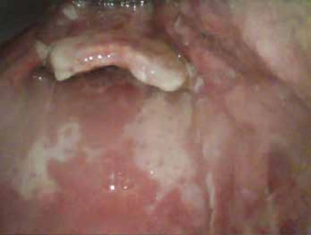 Epiglottis 7. den hospitalizace