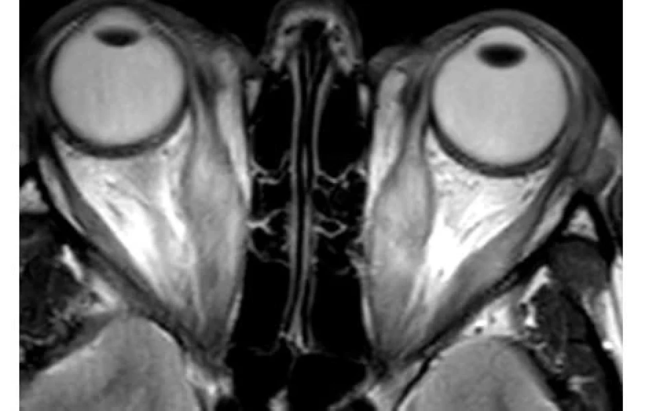 Obraz rozšířených okohybných svalů na MRI