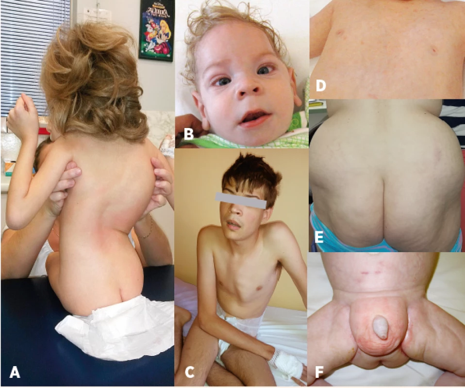 Charakteristický fenotyp: A – kostní deformity – skolióza, B – kraniofaciální
dysmorfie, strabismus, C – pectus carinatum, D – vpáčené bradavky,
E – atypická distribuce tuku v oblasti hýždí, F – atypická distribuce
tuku v oblasti genitálu.<br>
Fig. 2. Characteristic phenotype: A – bone deformities – scoliosis, B – craniofacial
dysmorphism, strabismus, C – pectus carinatum, D – nipples inversion,
E – atypical supragluteal fat distribution, F – atypical perigenital fat
distribution.