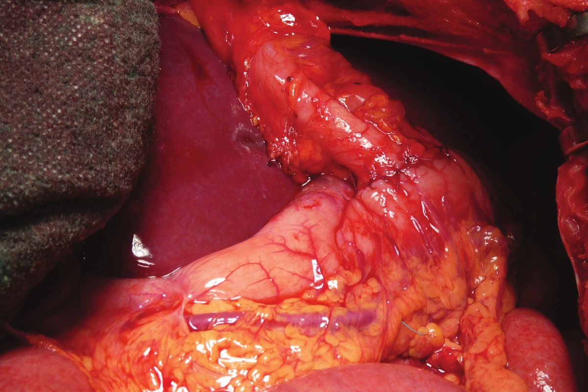 Anastomóza
aborální části kolon
s přední stěnou žaludku<br>
Fig. 7: Anastomosis of the
aboral part of the colon
with the front wall of the
stomach