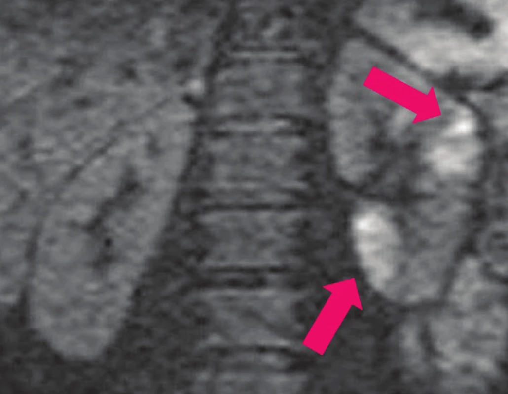 DW-MRI: víceložiskové zánětlivé změny v parenchymu ledviny
v akutní fázi pyelonefritidy (světlé–bílé hypersignální oblasti).